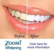 Zoom Whitening!  Whitening in one hour!