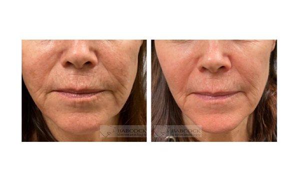 Laser treatments to help reduce brown spots, redness, and improve skin texture.