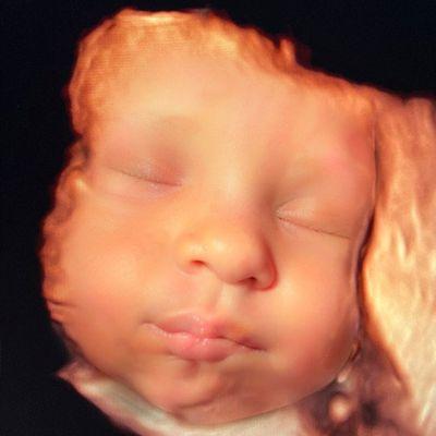 3D/4D/HD-LIVE ULTRASOUND