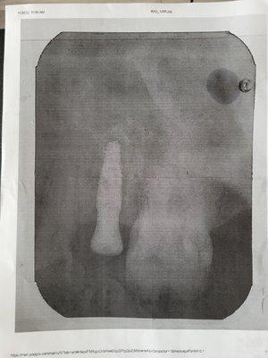 X-Ray done at Regency Square Mall Dental - of the wrong tooth, according to Dr. Ospina.