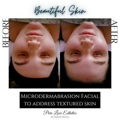 Client wanted smoother skin so I gave her a Microdermabrasion Facial.  She loved the end results!