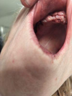 Mouth after 12 extraction nothing for pain.