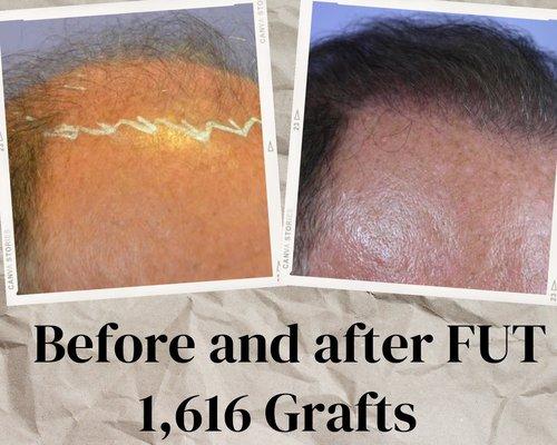 Before and after hair transplant surgery with Dr. Nicole Rogers