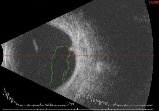 Ultrasound of eye with a retinal tear (red outline) from vitreous traction (green outline).