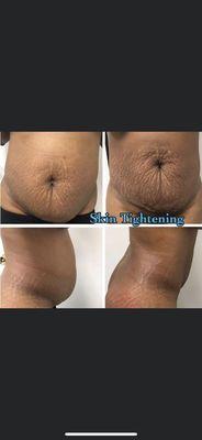 Skin tightening treatment