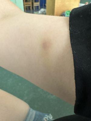 Pictures of bruises.