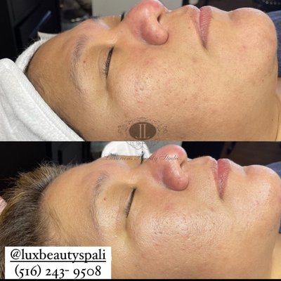 Microneedling with Mesotherapy