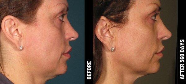 HIFU FACELIFT TREATMENTS