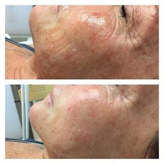 Before and After- 1 Non-Surgical Facelift treatment