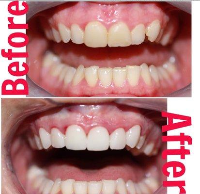 Five upper veneers and one crown!