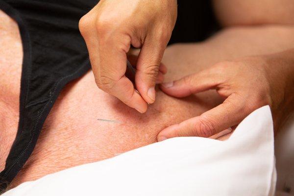 Acupuncture treatment