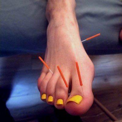 Part of an acupuncture treatment showing two Jing Well points and two other points on the feet