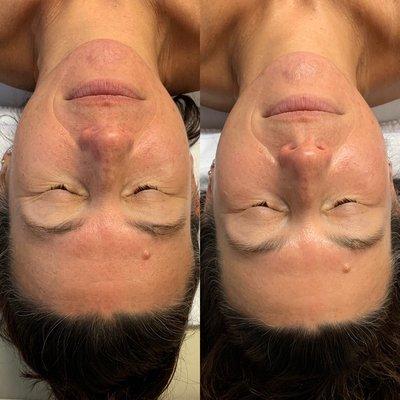 Before and after dermaplane and nano-needling