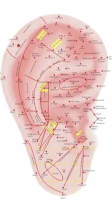 Pain Reduction via Auricular Therapy