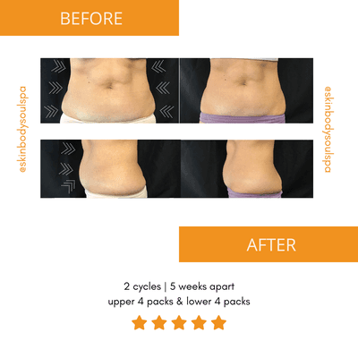 SculpSure is a non-invasive body contouring technique that targets, reduces, and permanently eliminates fat cells.