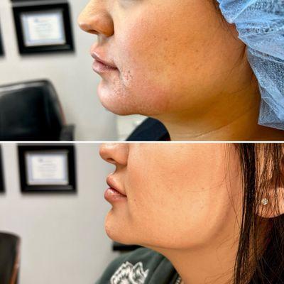 Jawline contouring and lip filler