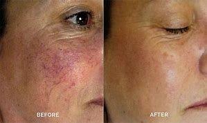 Photo Facial for Rosacea, extremely effective