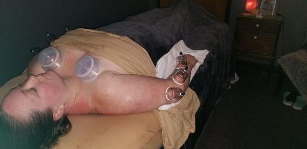 Cupping breaks up adhesions and separates fascia often bringing immediate relief from pain.