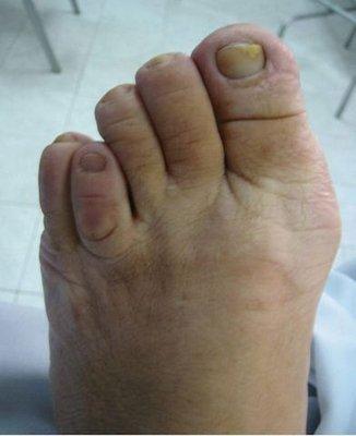 Bunions and foot deformities