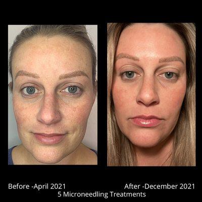 5 microneedling treatments