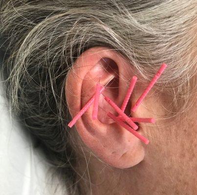 Auricular Acupuncture done on the outside/ external Ear. Come try it;-]