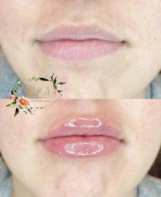 Needleless Lip Enhancement (Hya Pen)