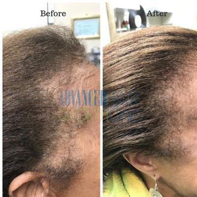 Thinning edges / traction alopecia - Treatment programs available