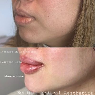 Lip and chin filler