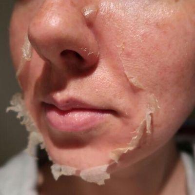 Perfect peeling results with The Perfect Derma Peel.