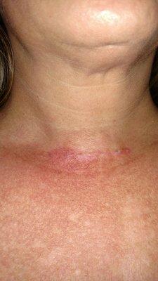 Day 16 post total thyroidectomy performed by Dr. Bianca Vazquez.