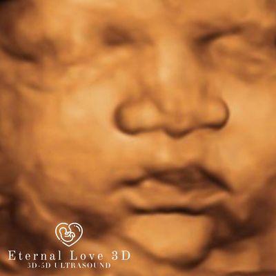 3D Ultrasound