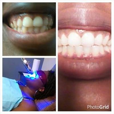 Teeth whitening results