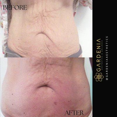 Before and after Thermalift treatments for skin tightening.