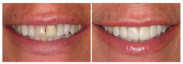 Dental Veneers