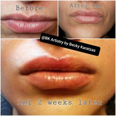 Needle-Free Lip Enhancement