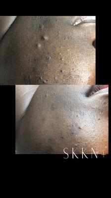 Before and After: Acne Management