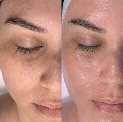 Deluxe Hydrafacial          ADD ON: Eye Perk