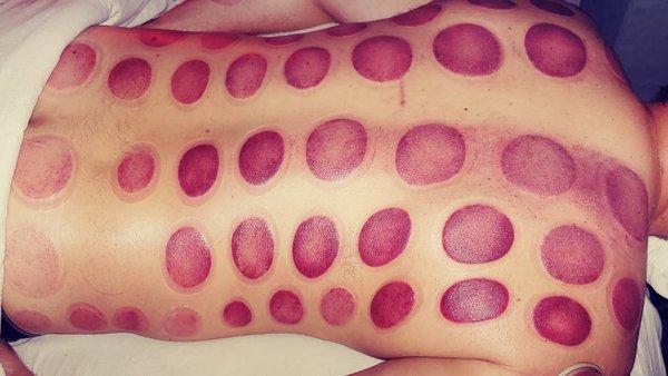 Cupping Therapy