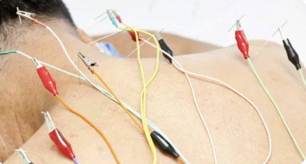 Electric Acupuncture: Stimulates the nerves to relieve pain and stimulates muscles to strengthen and rehabilitate them.