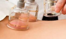 Cupping Therapy