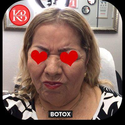 Botox treating glabellar, crows feet and Frontalis areas