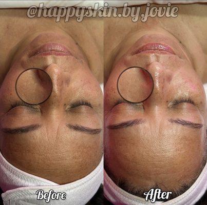 Anti-aging facial