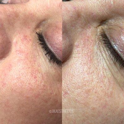 Treating broken capillaries