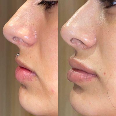 Lip filler before and after