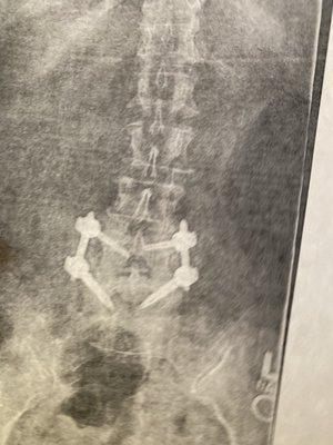 Spinal Xray