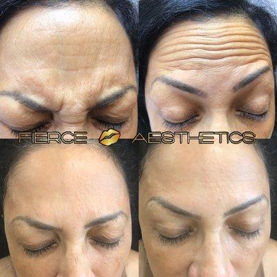 Wrinkle Reduction with Neurotoxin