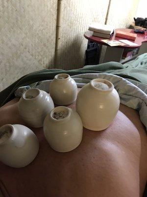 I can include traditional cupping.