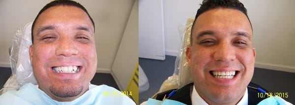 Invisalign Before and After