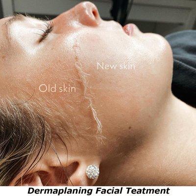 Advanced Dermaplaning