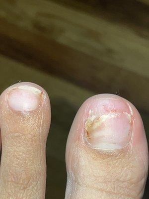 My toenails 3 weeks after my "pedicure "